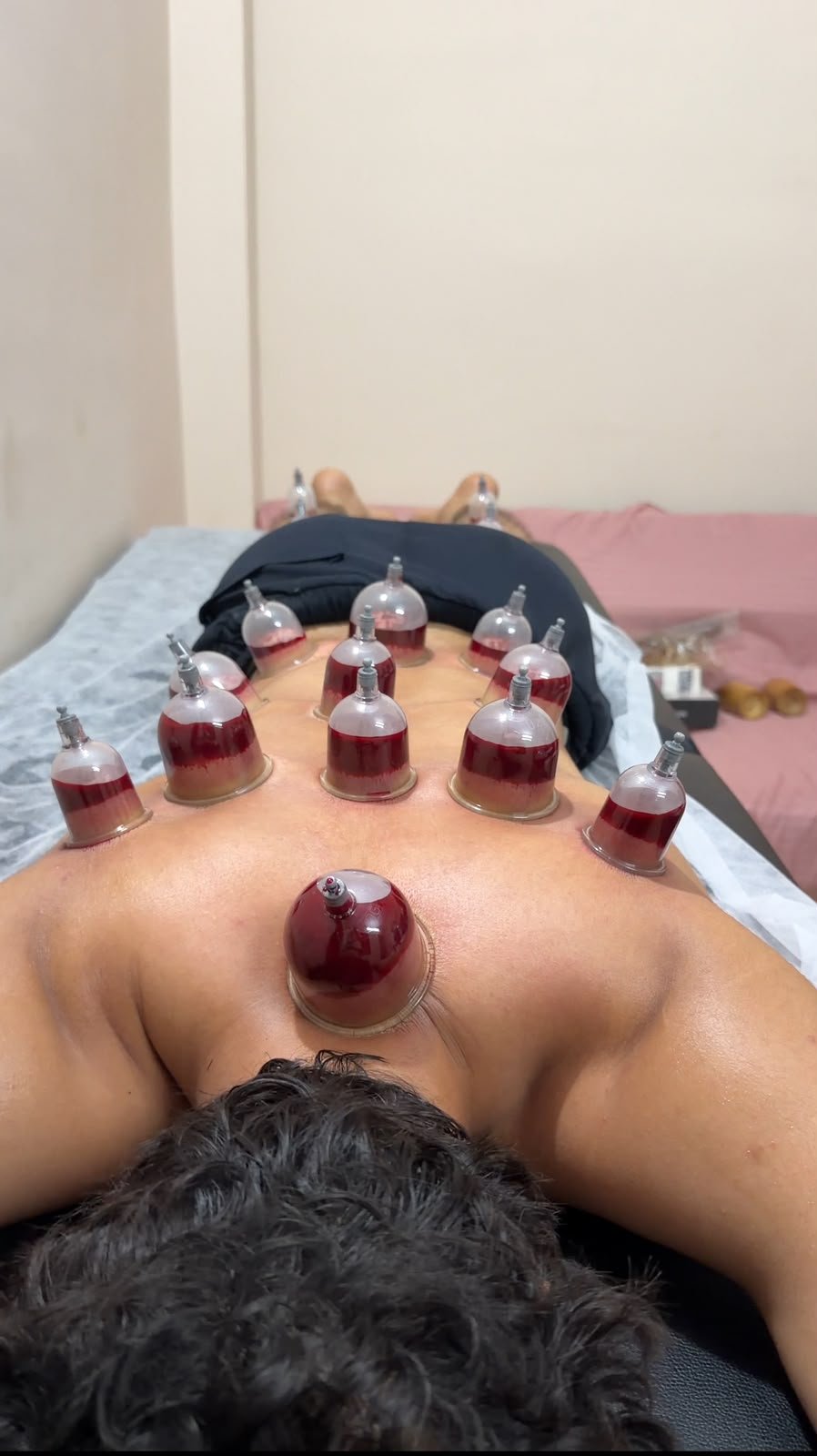 Sterile wet cupping treatment for hijama in bhatkal serving Honnavar patients